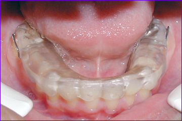 appareil orthodontique amovible gouttière mandibulaire de surélévation