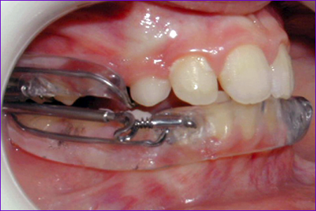 appareil orthodontique amovible Propulseur Universel Light ou PUL