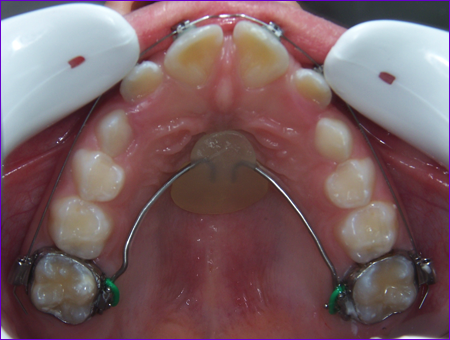 appareil orthodontique fixe: l