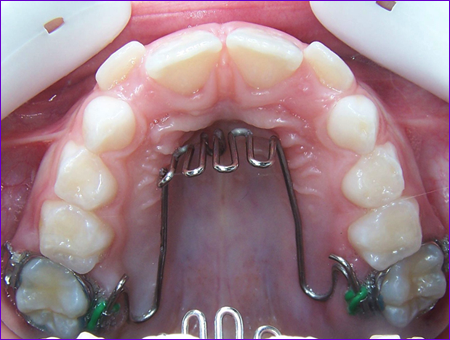 appareil orthodontique fixe:grille anti-pouce ou anti-langue