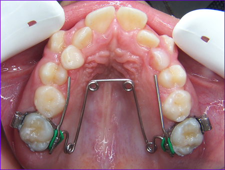appareil orthodontique fixe: le Quadhelix