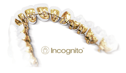 orthodontie-linguale-appareil-Incognito