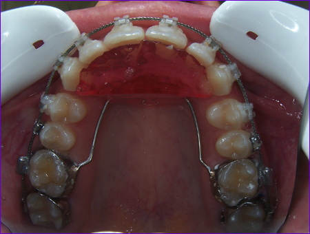 appareil-orthodontique-fixe-arc-de-Nance-avec-plan-de-surelevation-retro-incisif