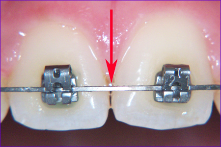 appareil-orthodontique-multiattache-Arc