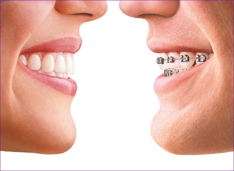 Comparaison-sourires-avec-aligneur-transparent-et-avecattaches-metalliques