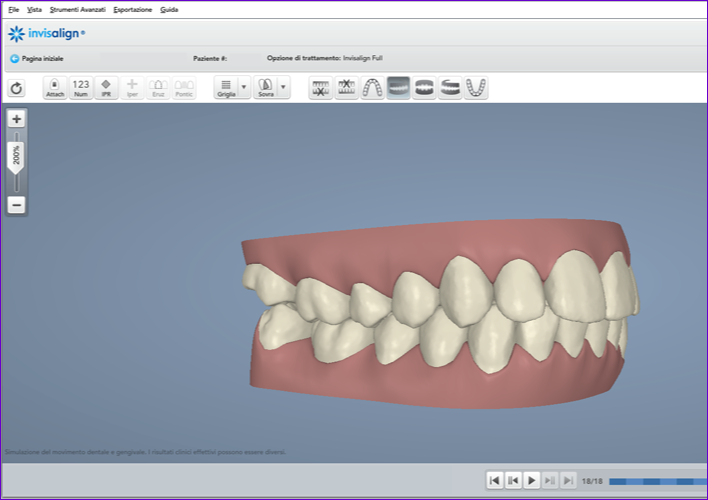 Previsionnel-de-traitement-informatique-3D-Invisalign-Clincheck