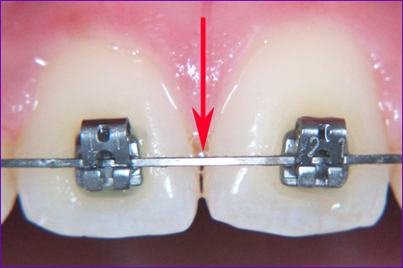 appareil orthodontique multiattache: l