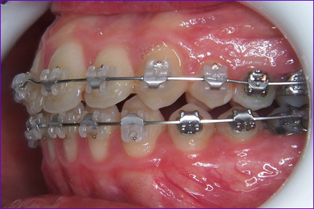 appareil orthodontique multiattache avec attaches autoligaturantes céramiques