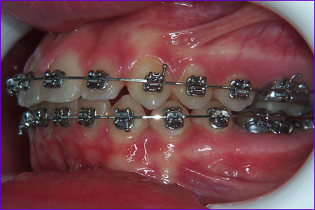 appareil orthodontique multiattache avec attaches autoligaturantes métalliques