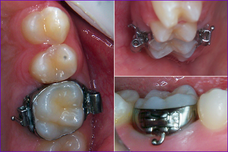 appareil orthodontique multiattache : la bague