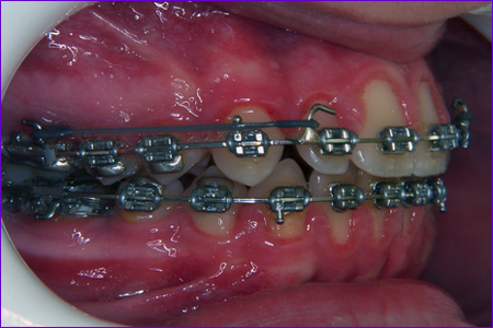 appareil orthodontique multiattache:Modules élastiques