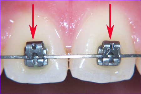 attach ou bracket ou verrou ou boitier pour appareil-orthodontique multiattache