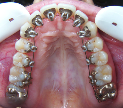Orthodontie:technique linguale Appareillage Incognito de l
