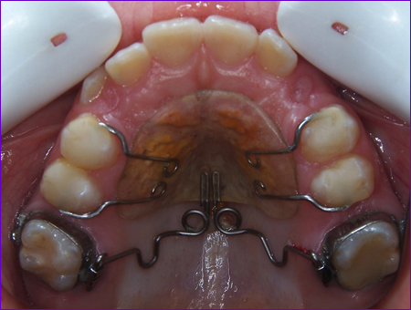 appareil orthodontique fixe: le Pendulum