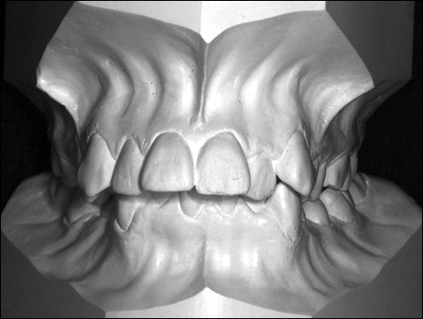 moulage-modele-orthodontique-taille-americaine-occlusion-face