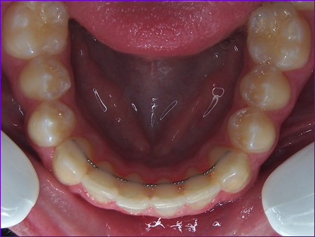 Orthodontie:Attelle de contention collée sur face interne des incisives et des canines inferieures