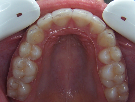 Orthodontie gouttiere transparente de contention