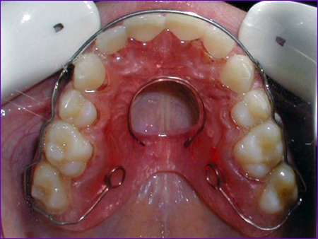 plaque de contention orthodontique dite plaque d