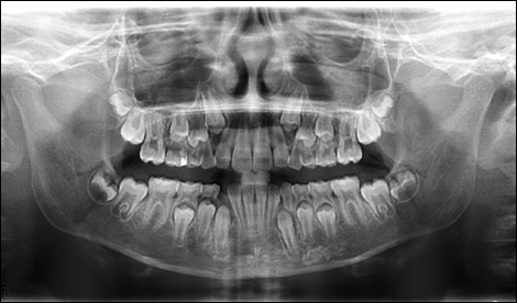 Radiographie panoramique en denture mixte