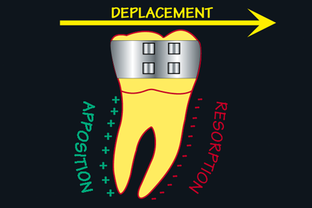 Reactions osseuses aux forces orthodontiques-Deplacement dentaire
