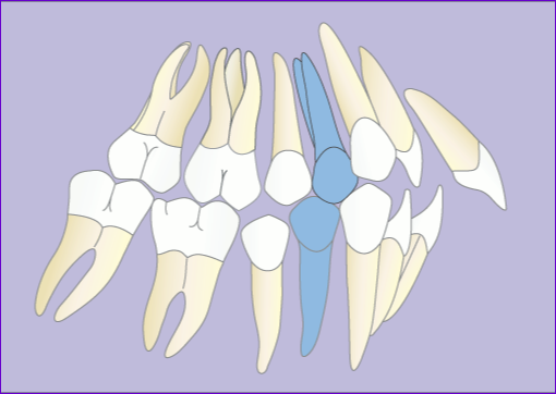 Orthodontie:Traitement multibague avec extraction 4 premolaires en 7images-Avant
