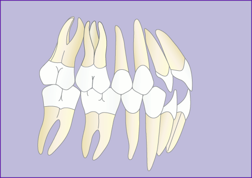Orthodontie:Traitement multibague avec extraction 4 premolaires en 7images-final
