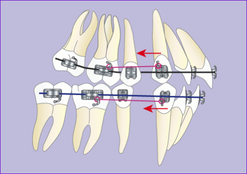 Orthodontie:Traitement multibague avec extraction 4 premolaires en 7images-phase 2