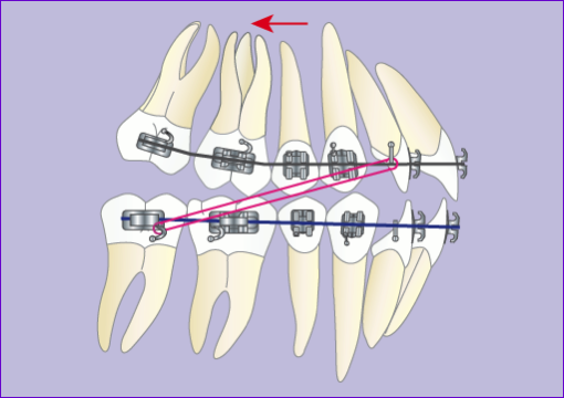 Orthodontie:Traitement multibague avec extraction 4 premolaires en 7images-phase 4