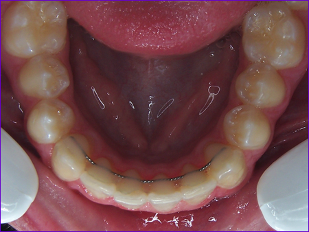 Attelle de linguale de contention orthodontique collée à a face interne des incisives et des canines infèrieures