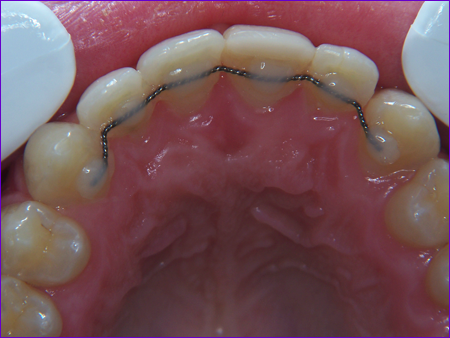 Attelle de linguale de contention orthodontique collée à a face interne des incisives et des canines supèrieures