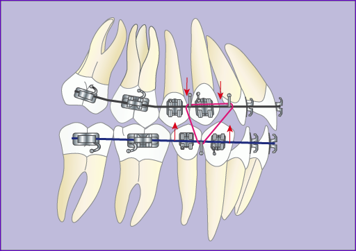 Traitement orthodontique multiattache avec extraction de 4 prémolaires en 7 images : finition de l