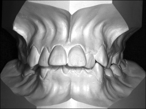 moulage ou modèle orthodontique en taille américaine