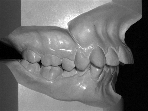 moulage ou modèle orthodontique en taille américaine