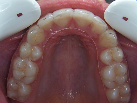 Orthodontie : gouttière transparente de contention