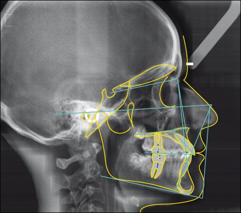 Orthodontie,tracé d