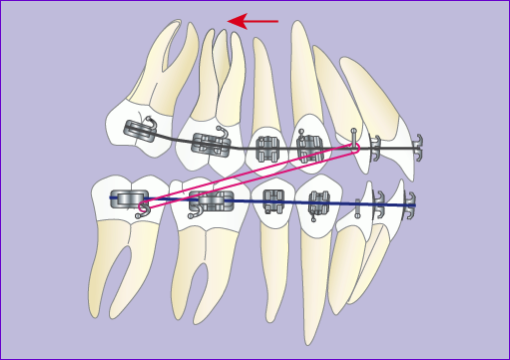 Traitement orthodontique multiattache avec extraction de 4 prémolaires en 7 images : correction du décalage des arcades dentaires