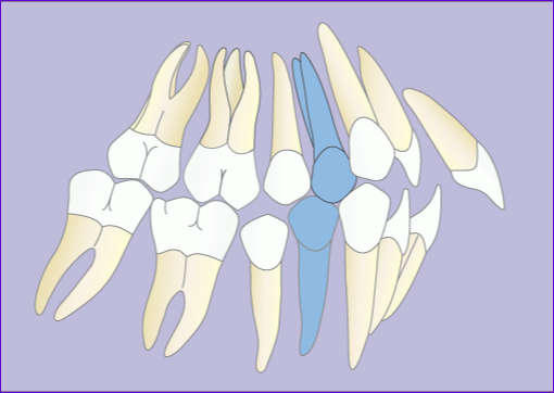 Traitement orthodontique multiattache avec extraction de 4 prémolaires en 7 images : extraction des prémolaires