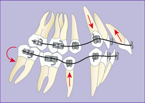 Traitement orthodontique multiattache avec extraction de 4 prémolaires en 7 images : phase 1 alignement et nivellement des arcades, recul des canines