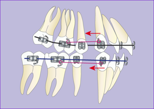 Traitement orthodontique multiattache avec extraction de 4 prémolaires en 7 images : phase 2 fin du recul des canines et de l