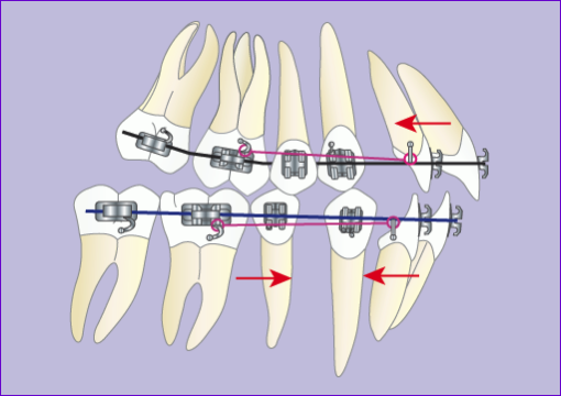 Traitement orthodontique multiattache avec extraction de 4 prémolaires en 7 images : recul des incisives