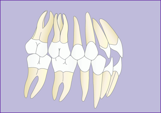 Traitement orthodontique multiattache avec extraction de 4 prémolaires en 7 images : dépose de l