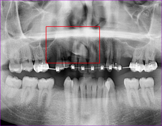 Panoramique dentaire avec canine maxillaire incluse  en position palatine 