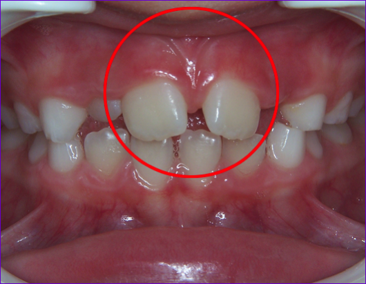 gros frein de lèvre supérieur provoquant un espace (diastème) entre les incisives centrales
