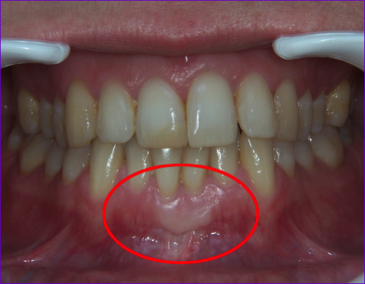 greffe de gencive (gingivale) sur les incisives centrales inférieures (mandibulaires)