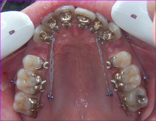 ancrage osseux temporaire ou mini-vis en position palatine avec appareil orthodontique lingual Incognito