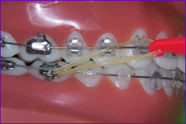 Orthodontie multiattache multibagues mettre les elastiques intermaxillaires-etape 3