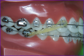 Orthodontie multiattache multibagues mettre les elastiques intermaxillaires-etape 4