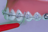 brossage dentaire avec appareil orthodontique-multiattache ou bagues-étape 7