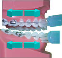 brossage dentaire avec appareil orthodontique-multiattache ou bagues-étape 1