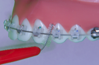 brossage dentaire avec appareil orthodontique-multiattache ou bagues-étape 7